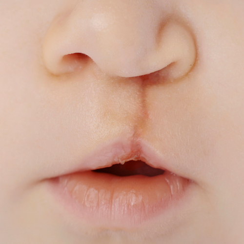 Language and Speech Problems Due to Cleft Lip and Palate