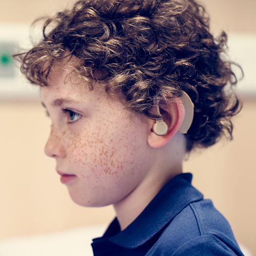 Language Disorders Due to Hearing Loss